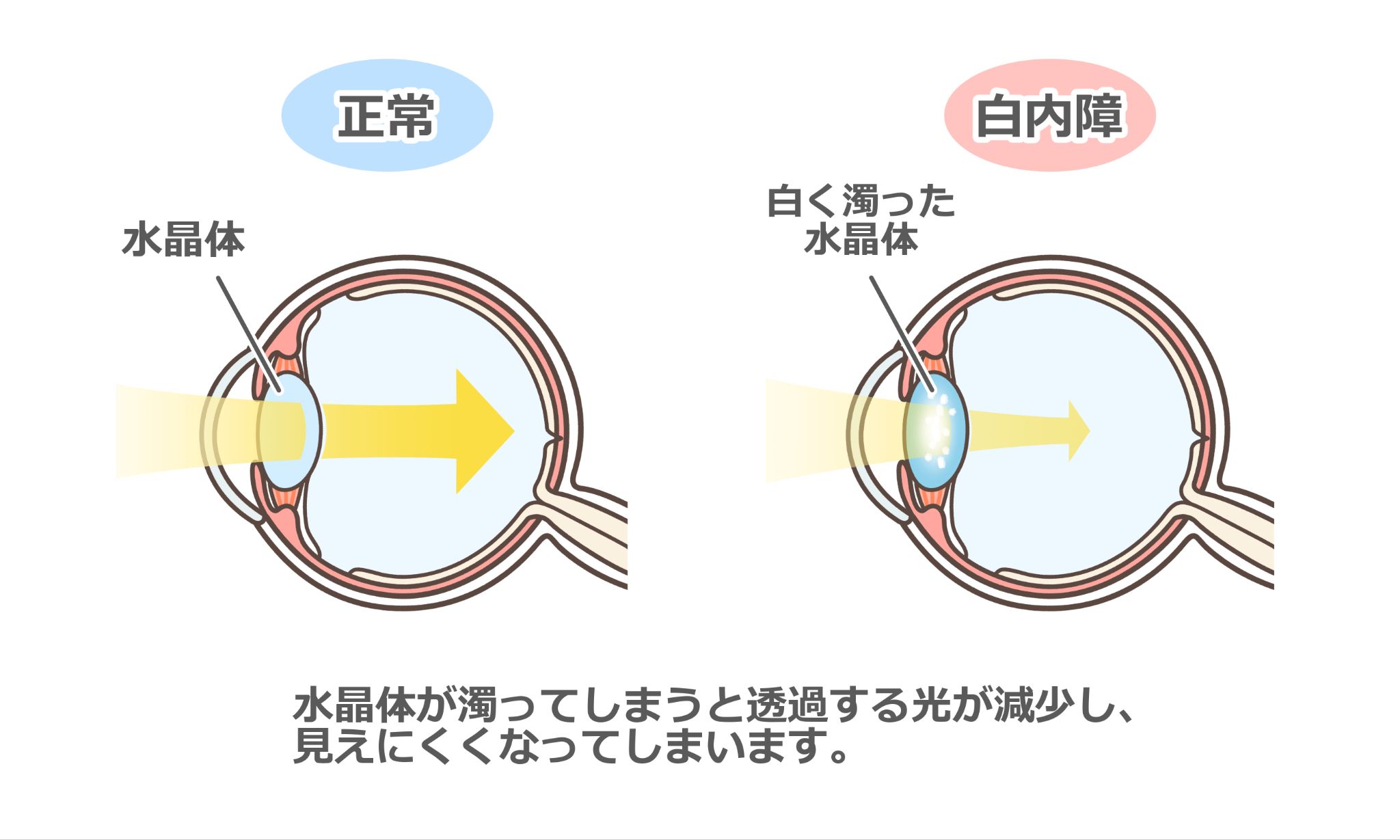 白内障はなぜ起きるのか