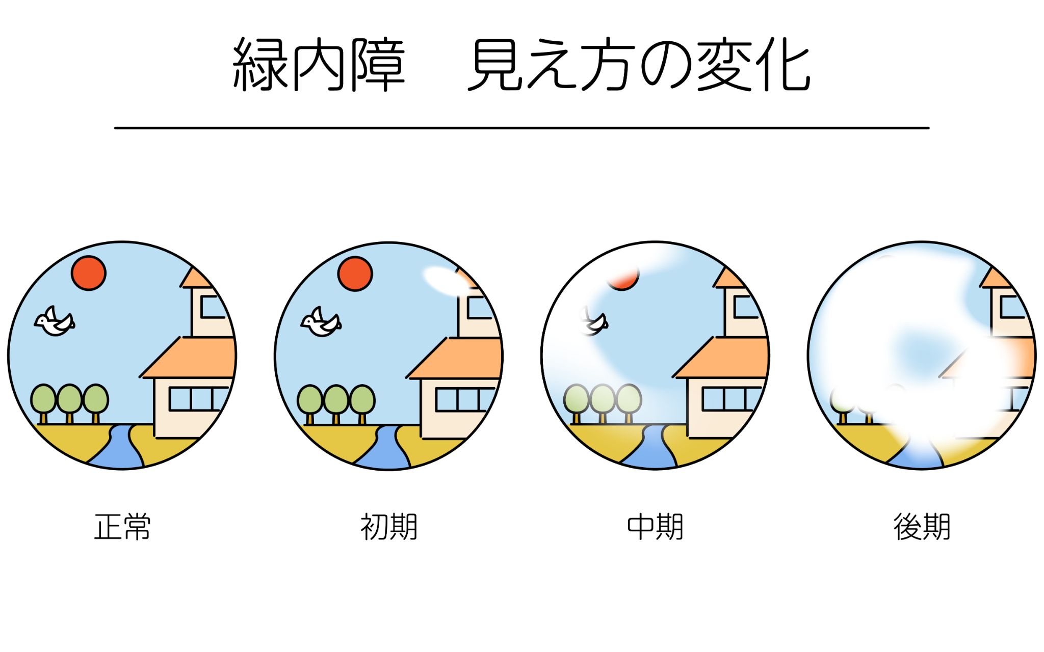 緑内障の初期症状に自分では気づけない理由