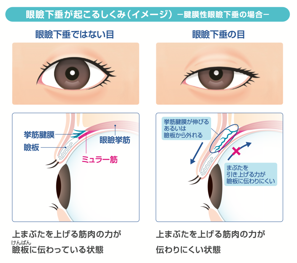 眼瞼下垂とは